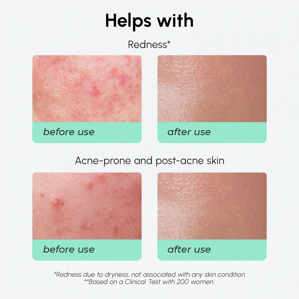 Rötungen beruhigendes Azelainsäure-Serum